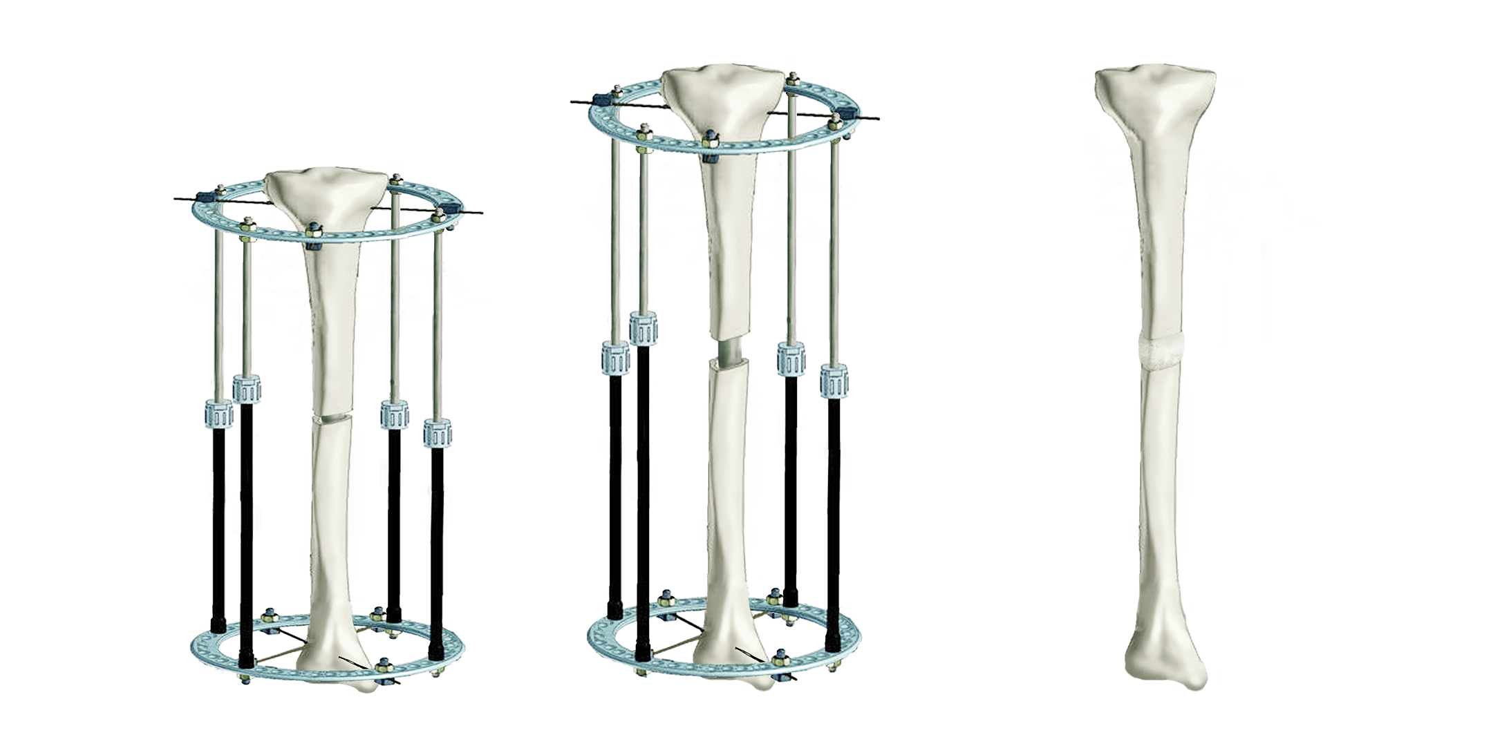 ILIZAROV monorail circular fixator method leg lengthening surgery
