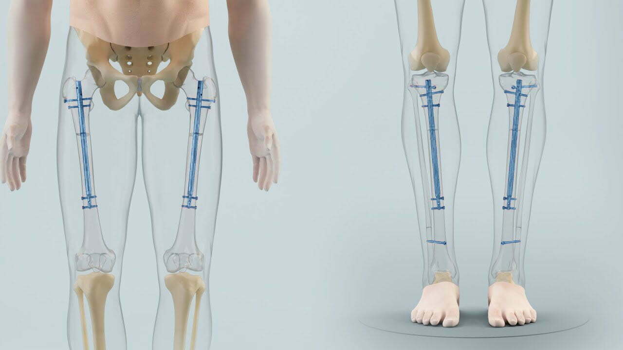 PRECICE 2 method cosmetic leg lengthening surgery