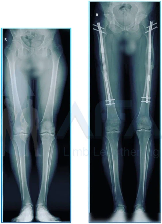PRECICE 2 method femur xray after leg lengthening recovery