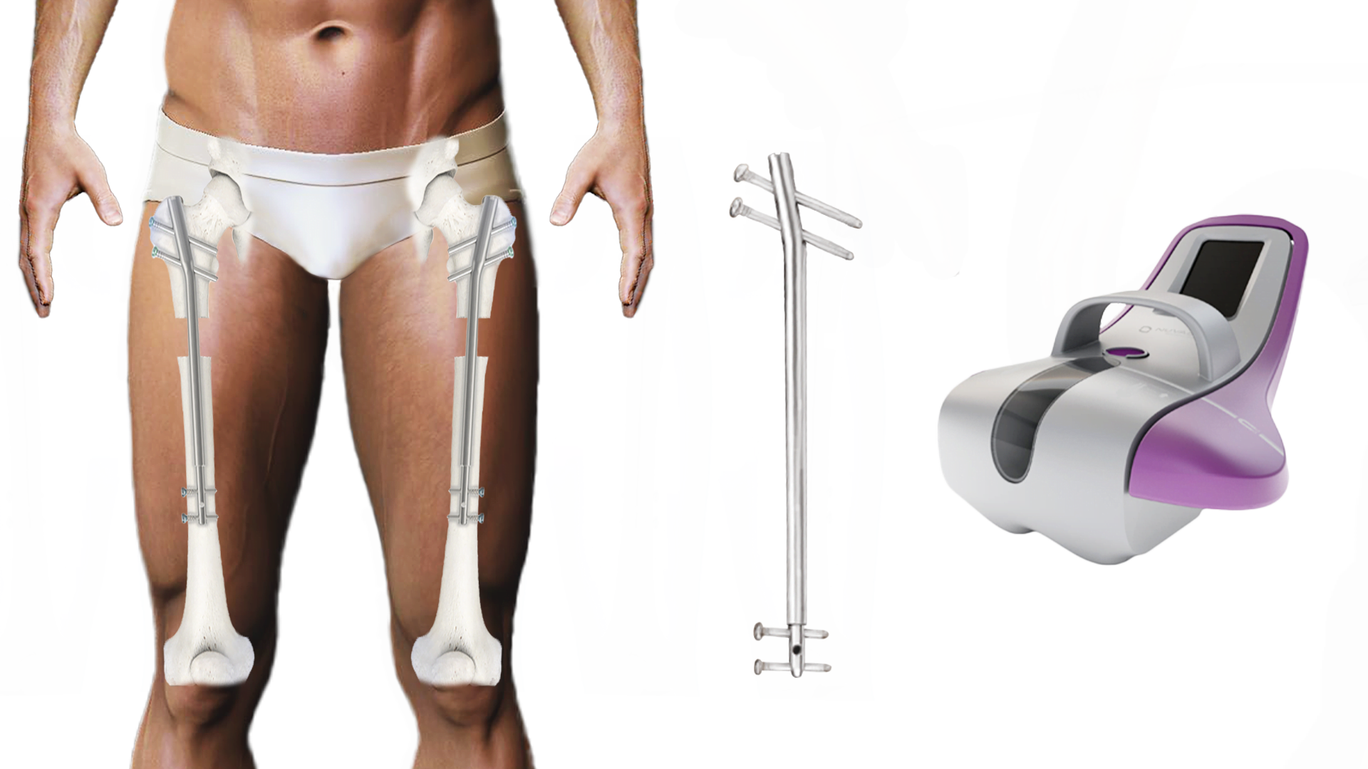 STRYDE method ERC for leg lengthening surgery