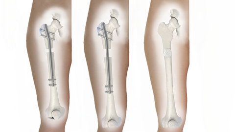 STRYDE method limb lengthening surgery nail afa