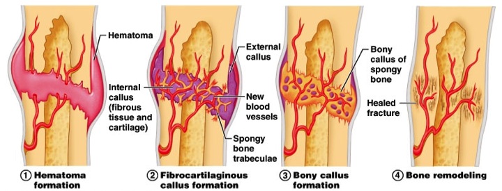 bone-healing-limb-lengthening