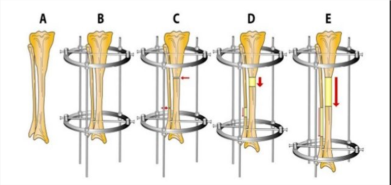 Distraction Osteogenesis in Limb Lengthening Surgery 4